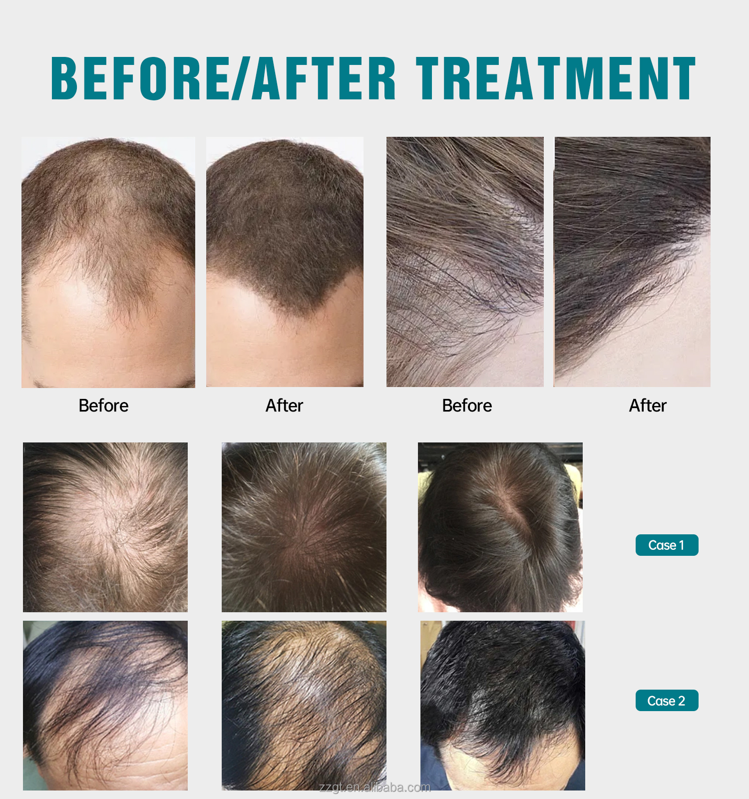 312 Diode Hair Growth Helmet,  - Hair Care Wella avaliação e preço